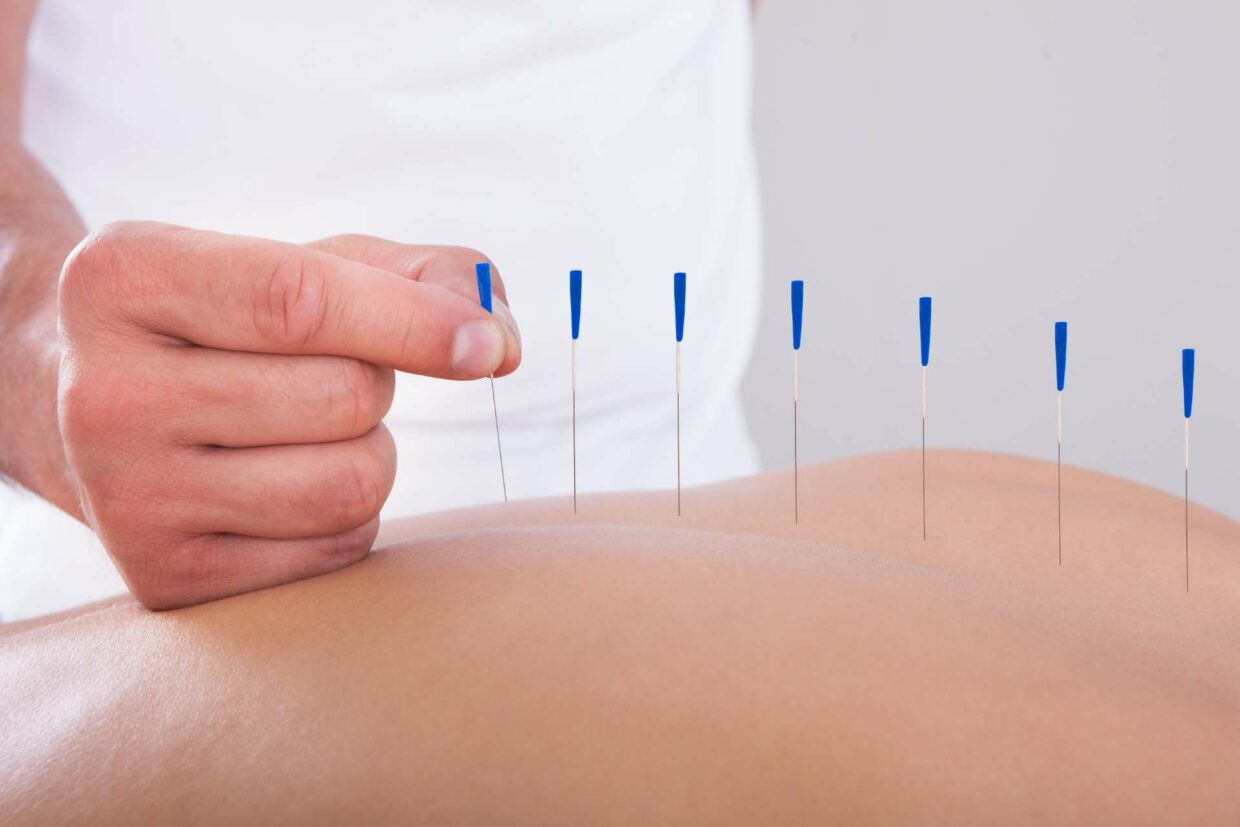 ACUPUNCTURE